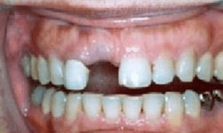 after dental implants