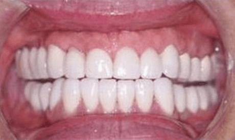 implants replacing missing back teeth