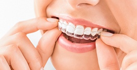 Closeup of patient putting on Invisalign clear aligners