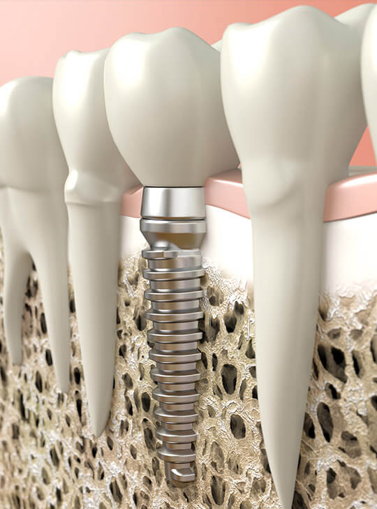 illustration on dental implant